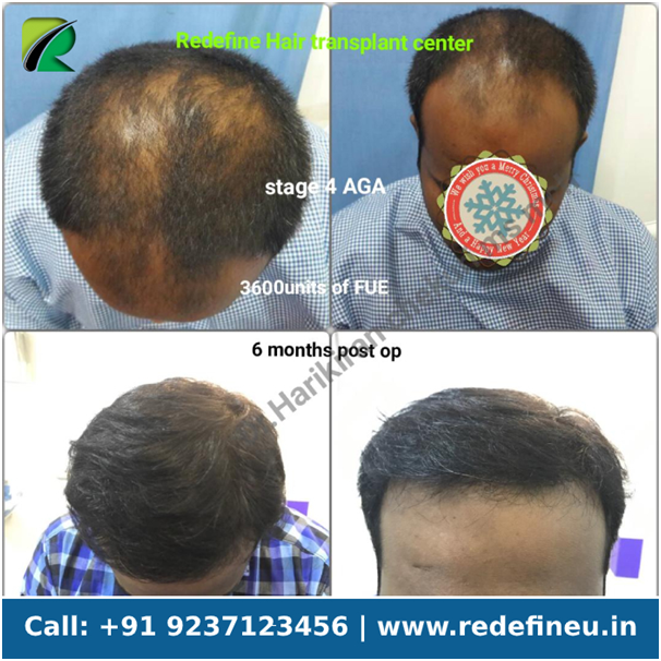 Post Hair Transplant Surgery of Mr.Chaitu