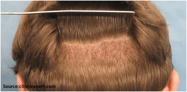 What is the Success Rate of a Hair Transplant?
