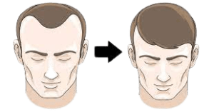 Robotic Hair Transplant in Hyderabad - View Cost | Redefine