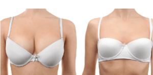 My breasts regrew eight years after I had surgery to reduce them