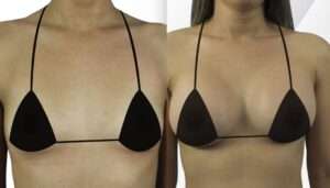 breast implant in hyderabad