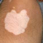 Focal vitiligo treatment in hyderabad