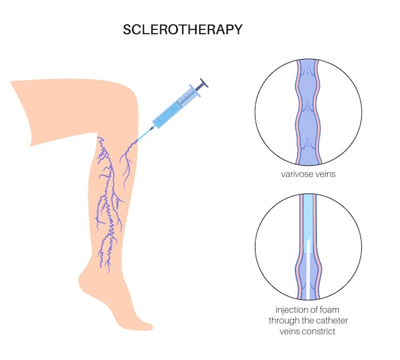 No Surgery; No Downtime: Sclerotherapy for Treating Varicose and Spider  Veins 