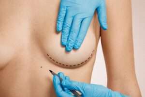 Reshaping the Breast Tissue