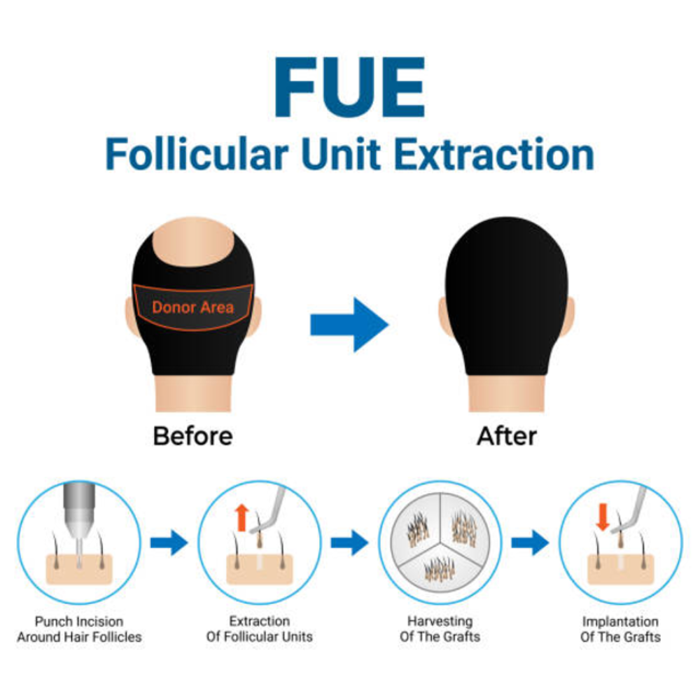 Follicular Unit Extraction (FUE) Hair Transplant