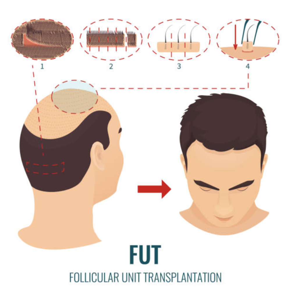 Follicular Unit Transplantation (FUT) Hair Transplant