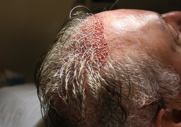 Follicular Unit Extraction (FUE) Hair Transplant