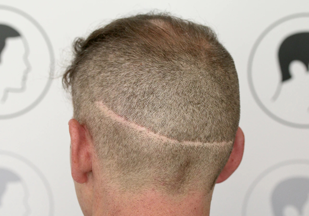 Bio-FUE Hair Transplant