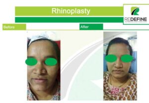 rhinoplasty before after