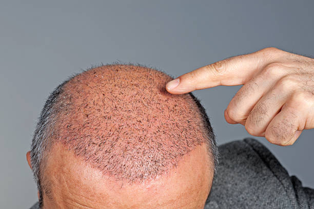 Recovery at 5 Weeks Post Hair Transplant