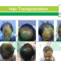 Before & After Hair Transplant Results