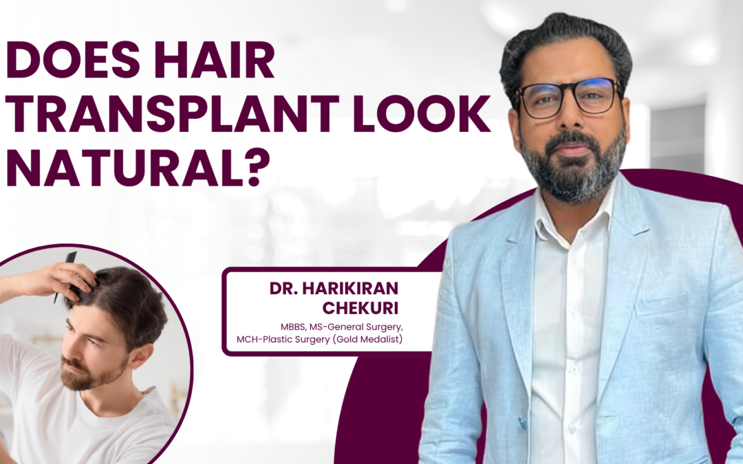 Does Hair Transplant Look Natural?