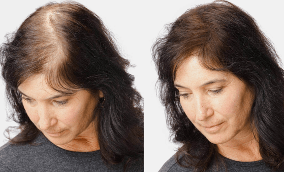 Female Hair Transplant in Hyderabad - View Cost | ReDefine Clinic