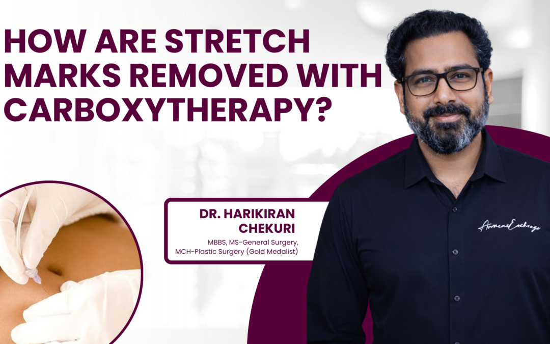 How Stretch Marks are Removed with Carboxytherapy?