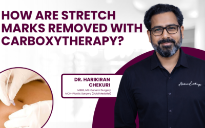 How Stretch Marks are Removed with Carboxytherapy?