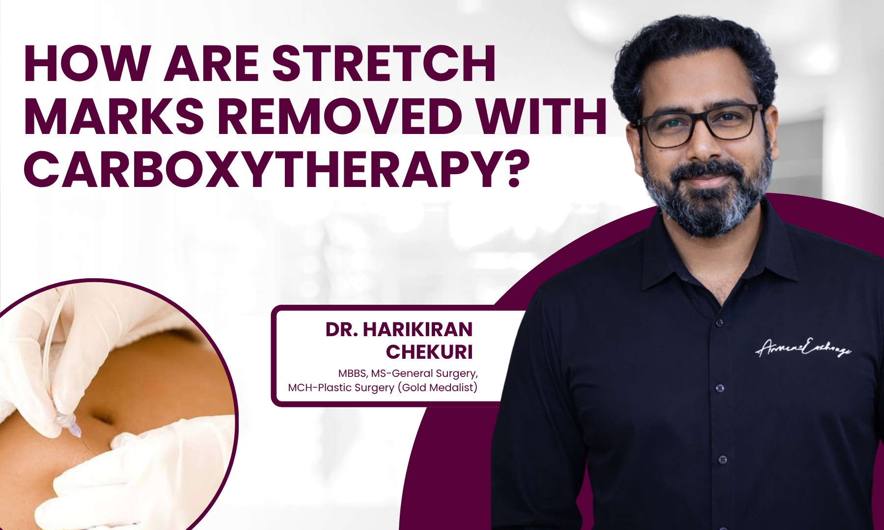 How Are Stretch Marks Removed with Carboxytherapy