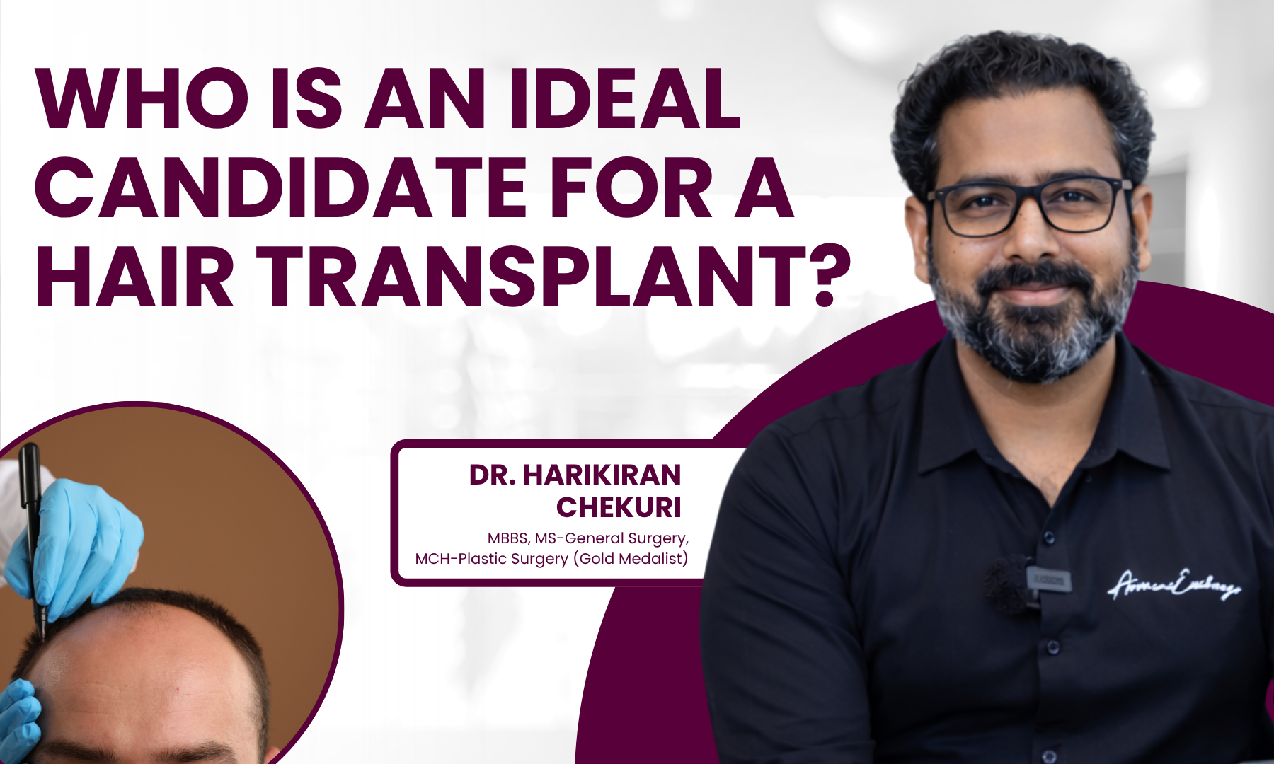 Who Is an Ideal Candidate for a Hair Transplant