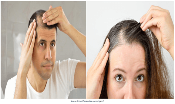 FUE Hair Transplant in Hyderabad-View Cost | Redefine