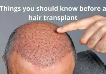 Things you should know before a hair transplant treatment