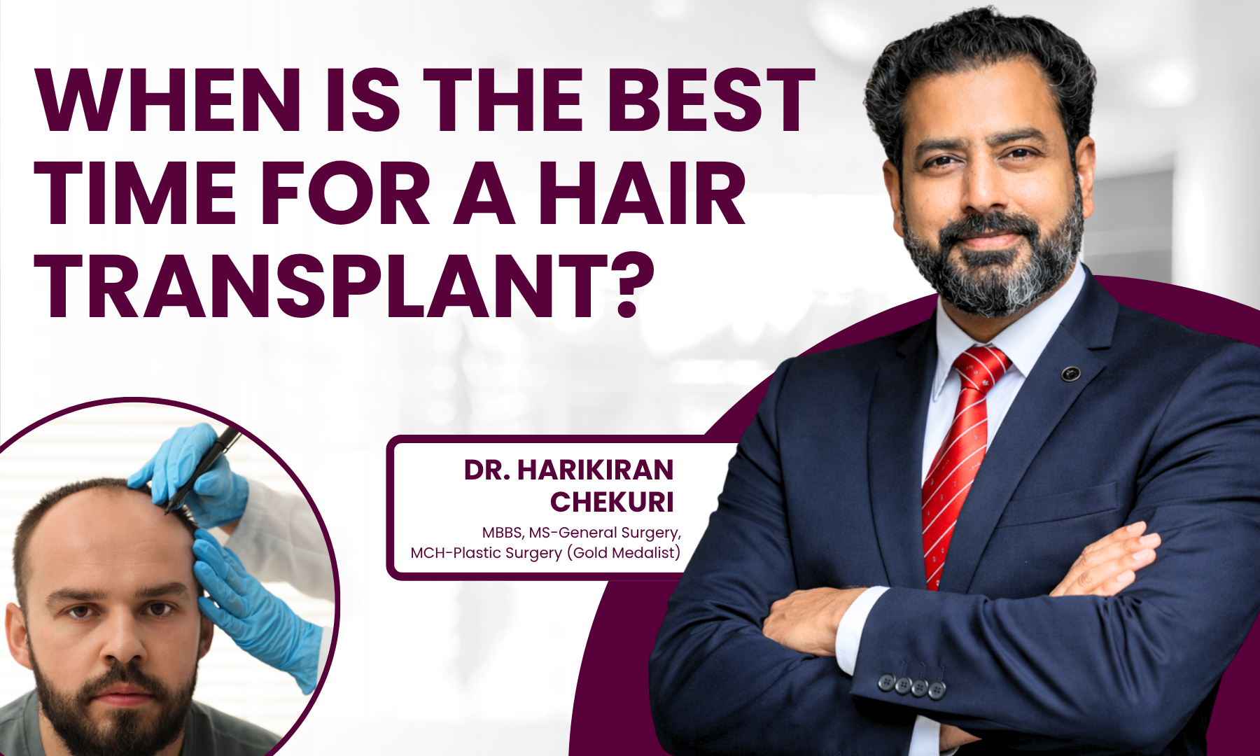 When Is the Best Time for a Hair Transplant