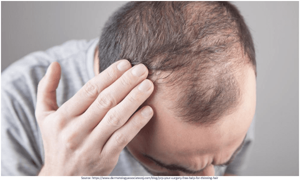 Bio-FUE Hair Transplant in Hyderabad-View Cost | Redefine