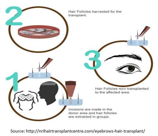 Eyebrow Transplantation Technique