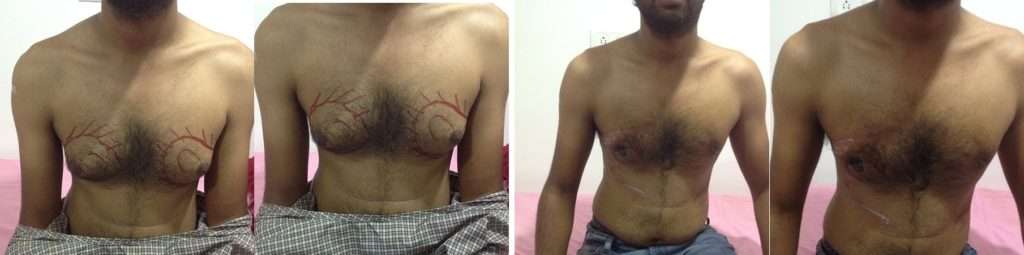 Male Chest reduction 1024x255 1