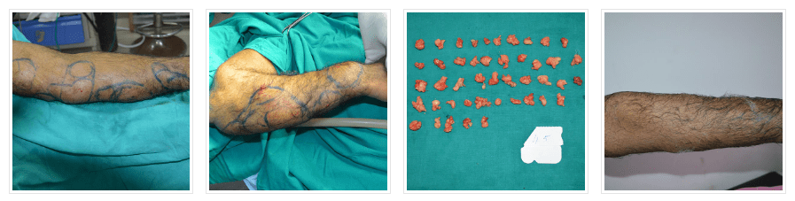 lipoma before after