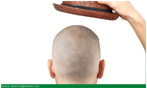 avoid scalp