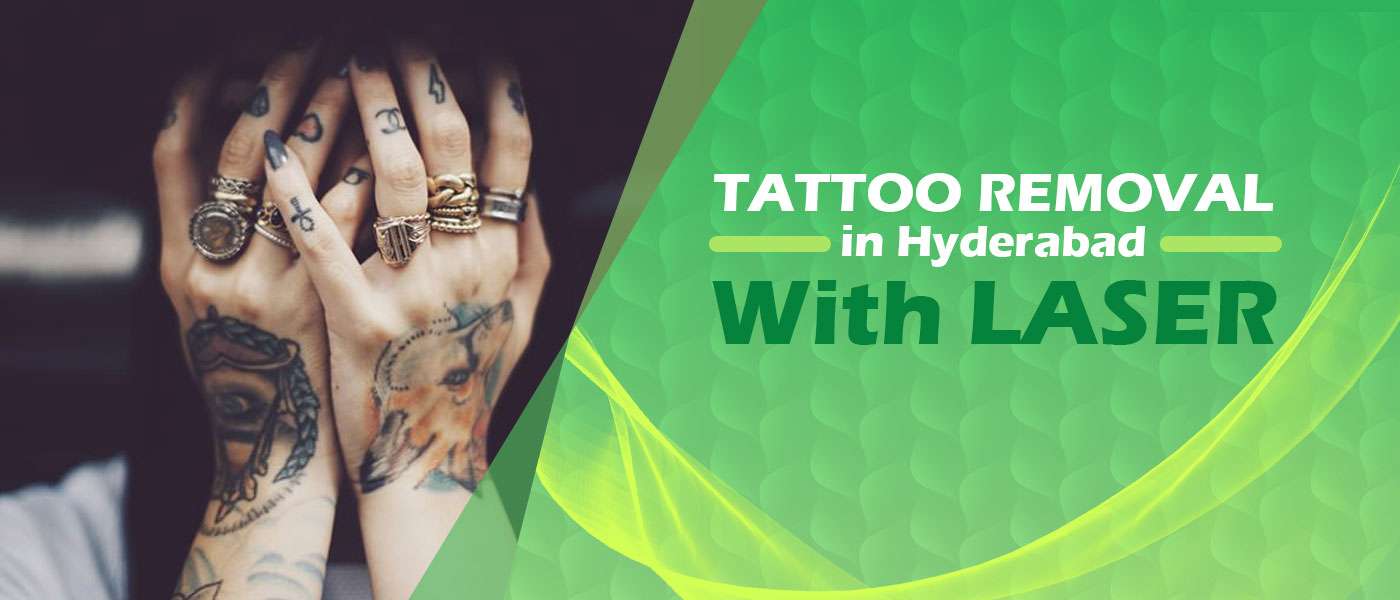 Laser Tattoo Removal Treatments | Sacramento CA