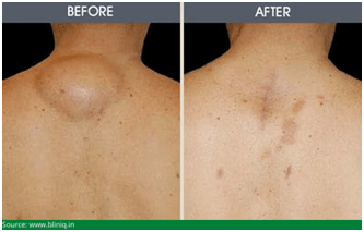 lipoma before after1