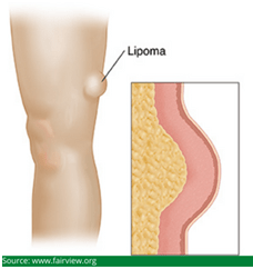 lipoma blog