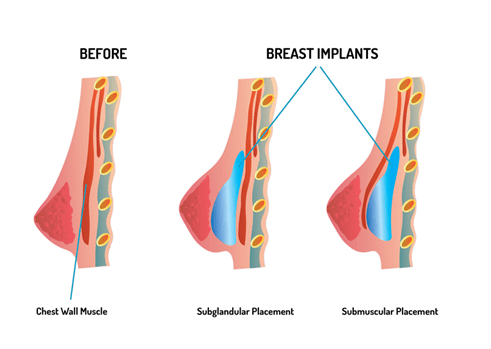 before after breast