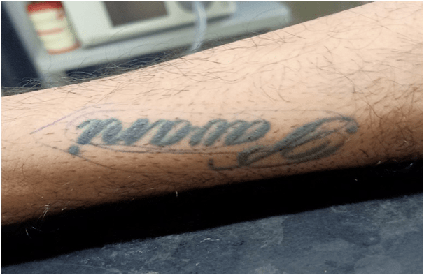 Tattoo Removal by Surgical Excision Method | Redefine