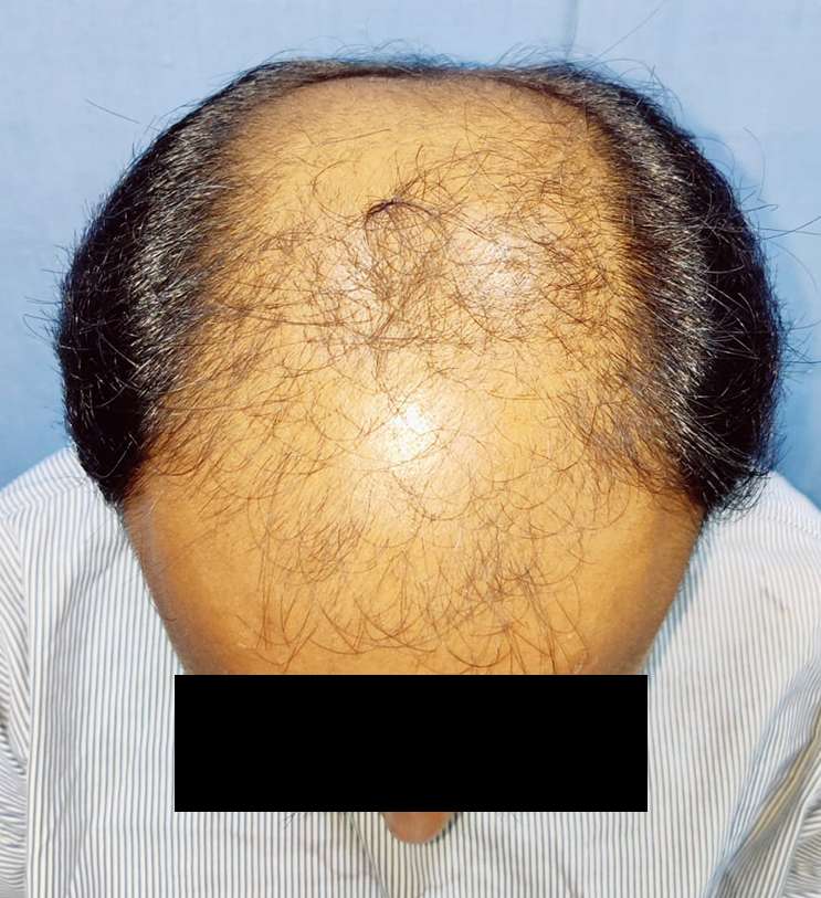 Hair transplant results