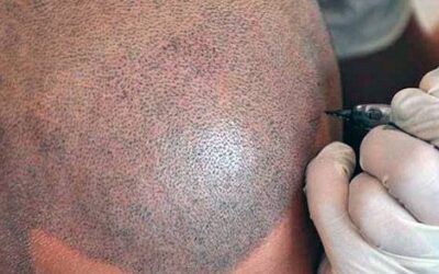 Scalp Micropigmentation with Hair Treatment in India