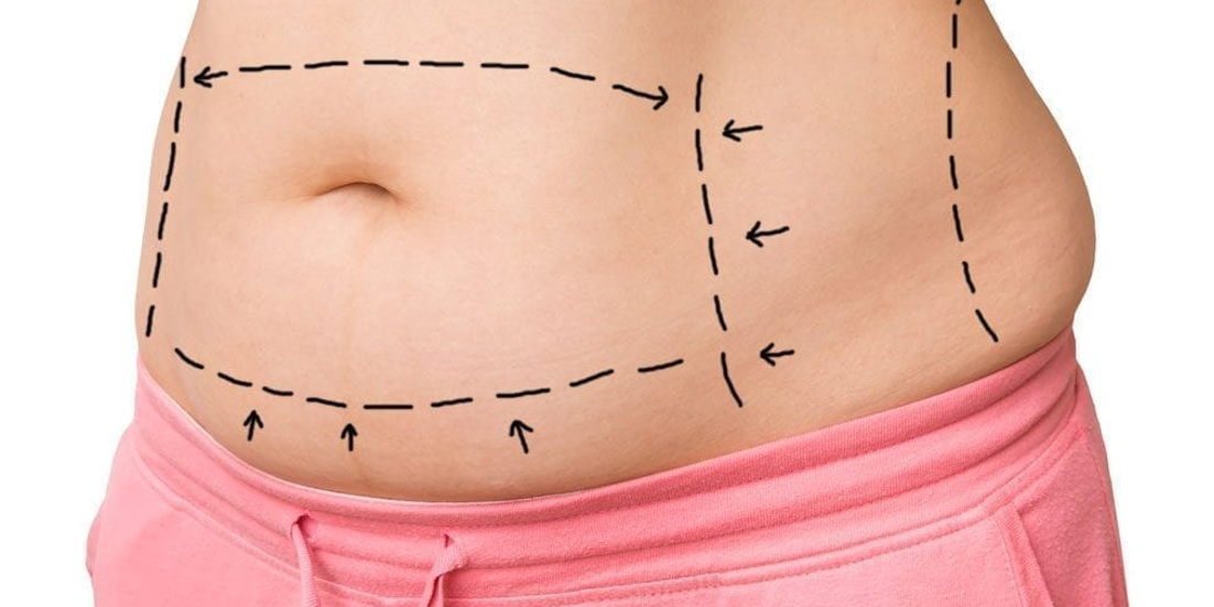 Tummy Tuck for Obese Patients