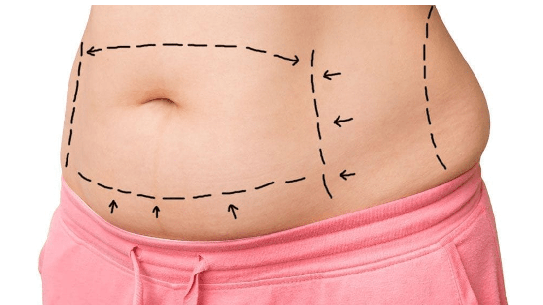 Tummy Tuck for Obese Patients