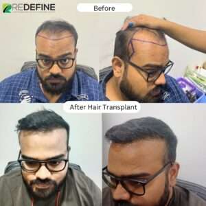 Top Hair Transplant Clinics in Tiruchirappalli Cantt Trichy  Best Hair  Transplant Doctors  Justdial
