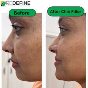 Before & After Chin Filler in Hyderabad