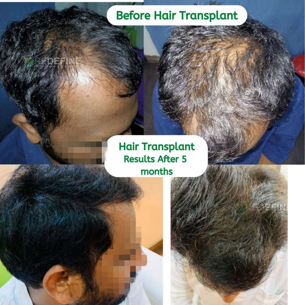 Redefine Hair Transplant | Dr. Harikiran