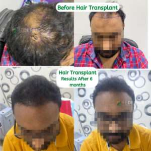 What are some good hair transplant centres in Hyderabad? - Quora