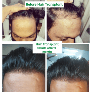 Hair transformation