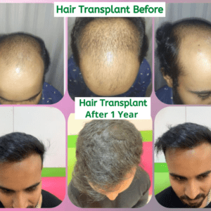 NonSurgical Hair Replacement In Hyderabad Bangalore Vijayawada  VizagTirupati rajamundry RKHairStudio