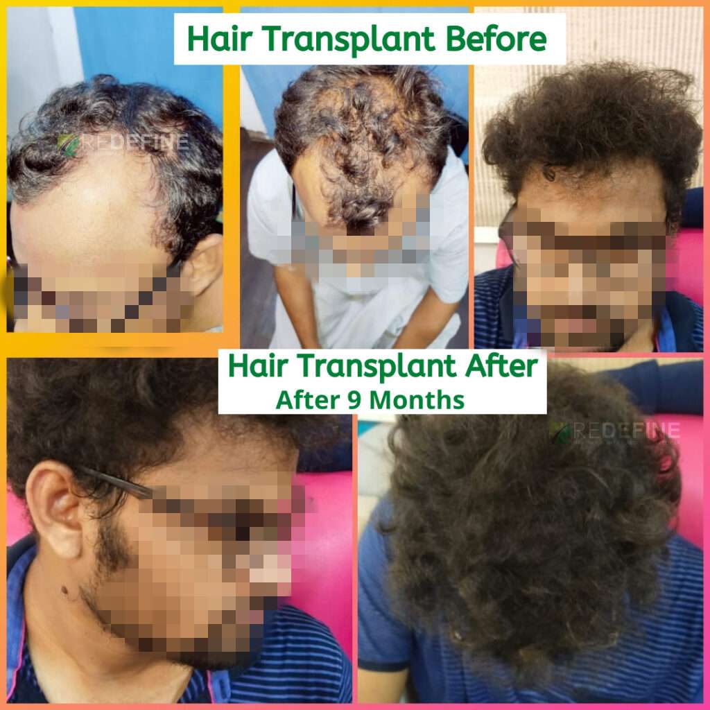 Redefine Hair Transplant | Dr. Harikiran