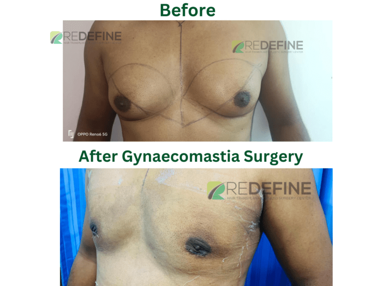 After Gynaecomastia Surgery 1