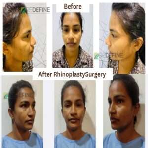 Rhinoplasty surgery in hyderabad