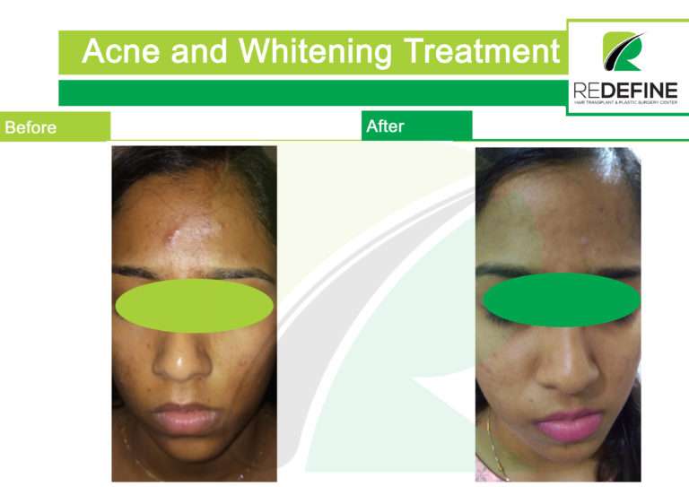 Permanent Skin Whitening Treatment in Hyderabad Redefine