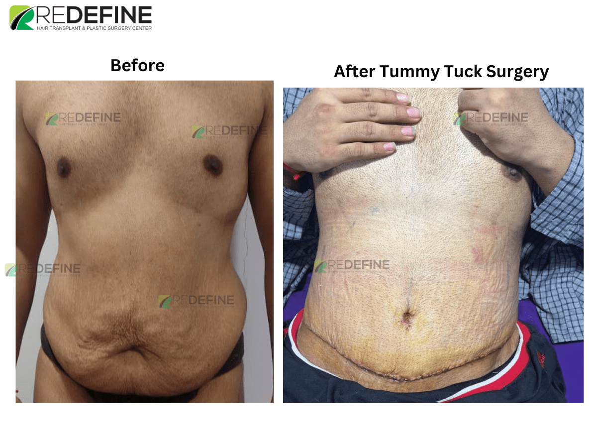 Tummy Tuck Surgery in Hyderabad - View Cost