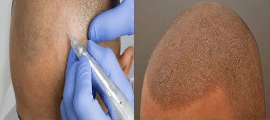 Advantages of Scalp Micropigmentation